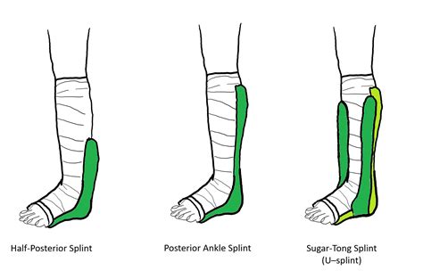Ankle Splnt Posterior Splint Kit