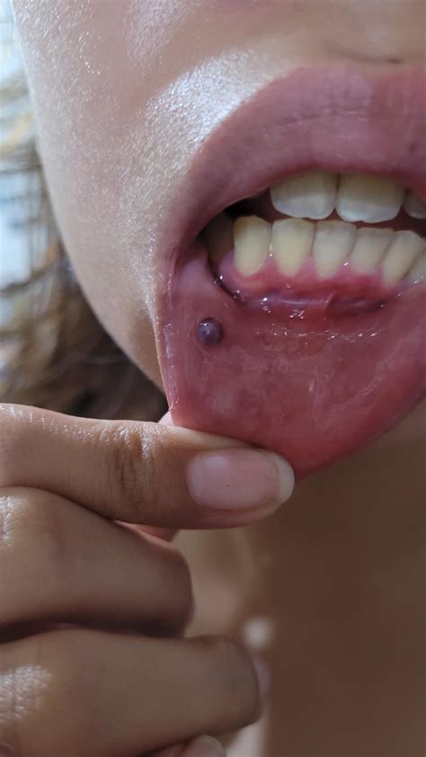 purple lump inside lower lips with pics : r/askdentists