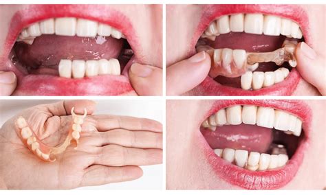 Prosthetic Dentistry - Botanikx Clinic