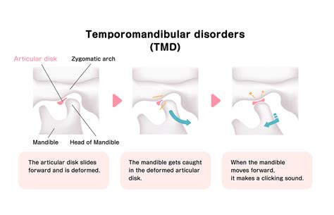 Tmj Vs Tmd