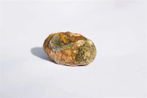 Understanding Gallstones: Formation, Risk Factors & Treatments ...