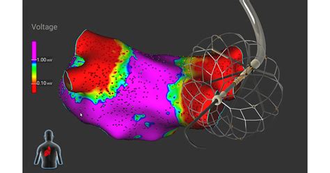 The Medtronic Sphere-360™ Pulse Field Ablation (PFA) catheter, a new ...