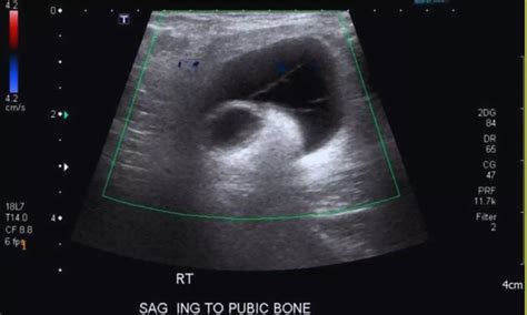 Meshoma: Rare Late Complication of Inguinal Hernia Detectable by ...