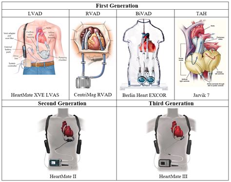 Cardiac Assist Devices: Early Concepts, Current Technologies, and ...
