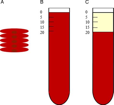Erythrocyte Sedimentation Rate, ESR Blood Test Uses, Results