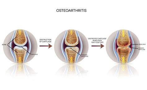 Osteoarthritis of the knee: Stages, diagnosis, and treatment
