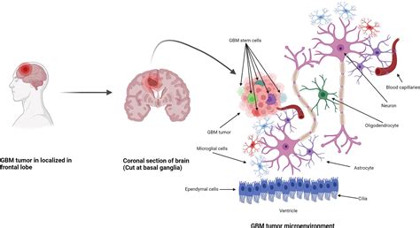 Frontiers | An overview of glioblastoma multiforme and temozolomide resistance: can LC-MS-based ...