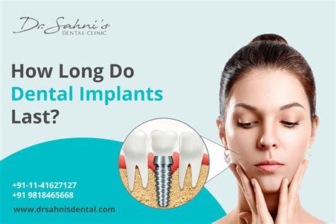 Do Dental Implants Last Forever | How long do Dental Implants Last?