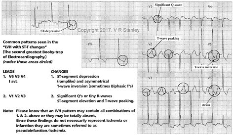 Left ventricular hypertrophy electrocardiogram - wikidoc