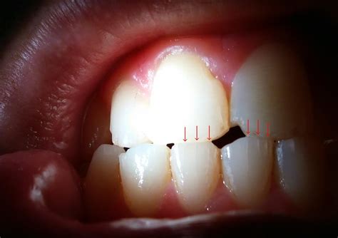 Hairline Cracks In Teeth