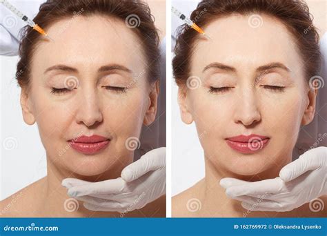 Forehead Plastic Surgery Before And After. Middle Age Woman Wrinkled Face Close Up. Facial ...