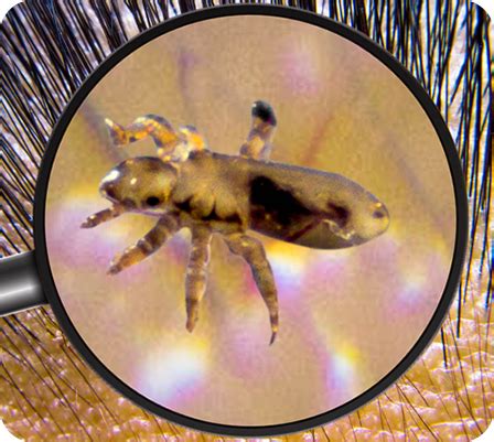 What Are Lice? | Nix® Lice Treatment