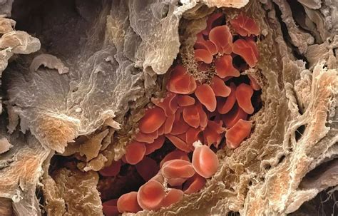 Dalteparin bridging does not prevent arterial thromboembolism in AF ...