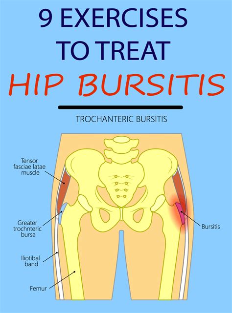 What Is Trochanteric Bursitis Of The Hip at David Laramie blog