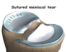 Physiocure | The sports Rehab clinic.