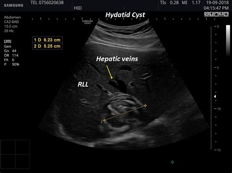 Hepatic Cyst