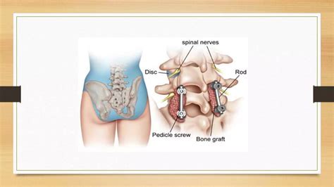 Image result for Spinal Stabilization Recovery