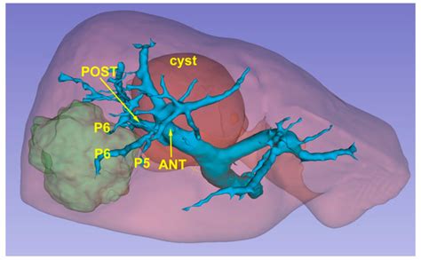 Laparoscopic Microwave Ablation: Which Technologies Improve the Results