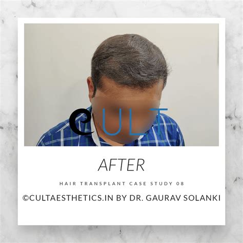 Hair Transplant Results 08Cult Aesthetics
