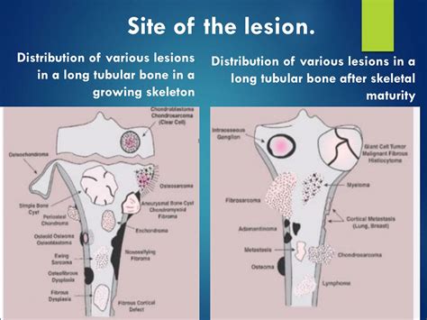 PPT - BONE TUMORS PowerPoint Presentation, free download - ID:237144