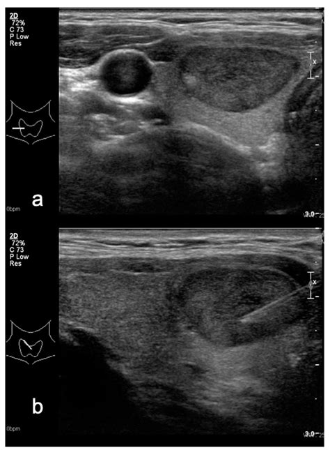 Non-Marked Hypoechogenic Nodules: Multicenter Study on the Thyroid ...