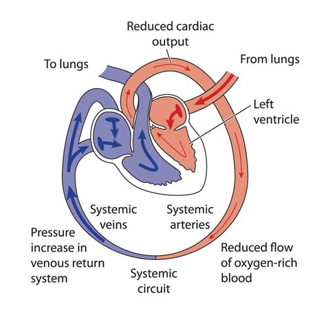 Heart Failure - DR. DEBARGHA DHUA - MBBS, MD, DM Cardiology