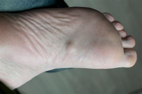 Plantar Fibromas Archives - University Podiatry Associates