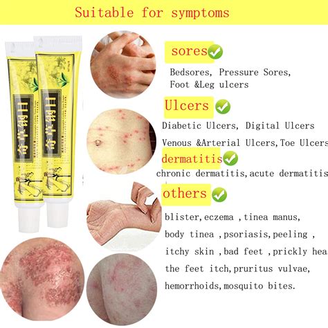 5pcs Lot Chinese Herbal Eczema, Psoriasis Cream,Eczema Cream Natural ...