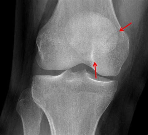 Xray Knee Aplateral Showing Fracture Patella Or Knee Cap