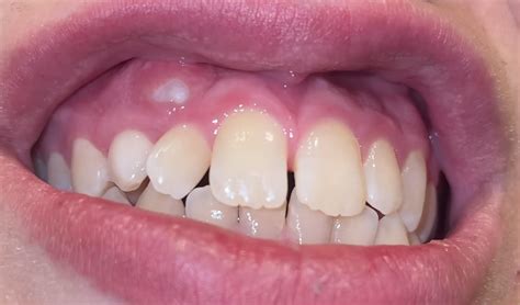 Painless Bump On Gums