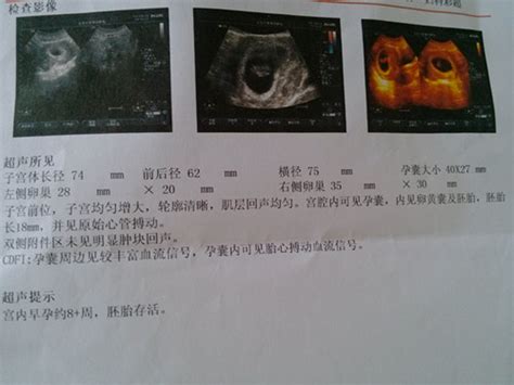 怀孕8周B超图，可以猜出宝宝性别不？_快问_太平洋亲子网