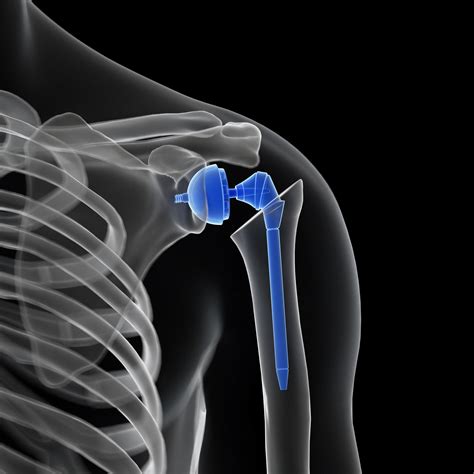 What Is A Shoulder Replacement Procedure at Ashley Pines blog