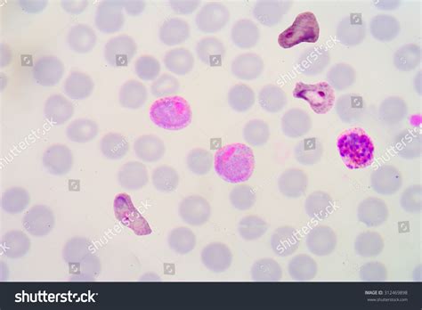Malaria Blood Smear Pictures: foto stock (editar agora) 312469898