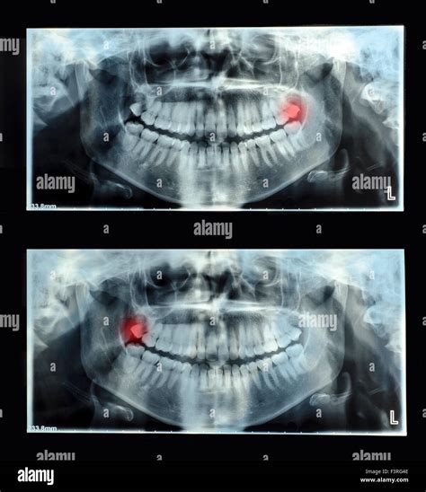 Panoramic dental x-ray with superior upper wisdom tooth (eight tooth) shown red. Double x-ray ...