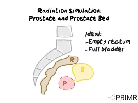 Prostate Radiation Simulation 的图像结果