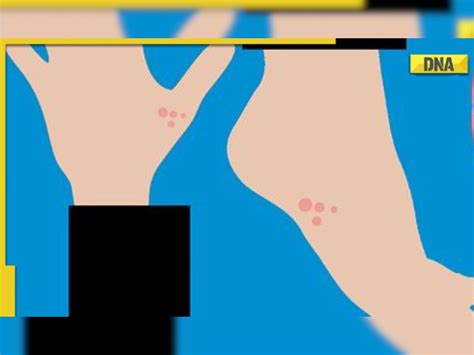 What causes fungal infections on the skin and how can they be prevented?