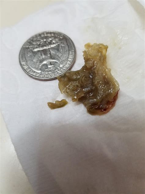 Nasal Scabs
