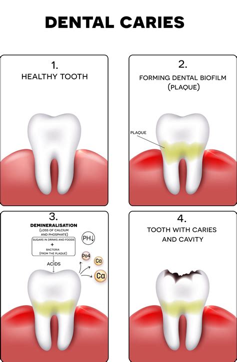 Cavities: The Detailed Guide | McLean, VA | Smile Mclean Dentistry