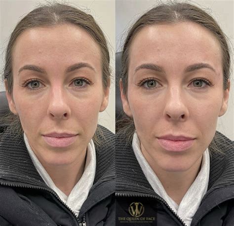 Temples - The Queen of Face -Medical Aesthetics & Skin Care - Edmonton