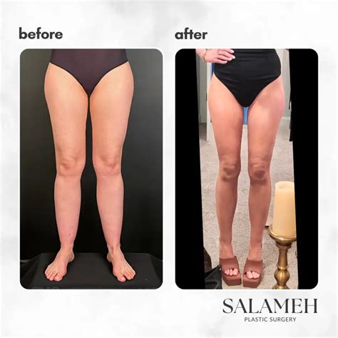 A Comprehensive Guide to Lipedema: Types, Causes, Symptoms, Stages, Treatments, & Prevention