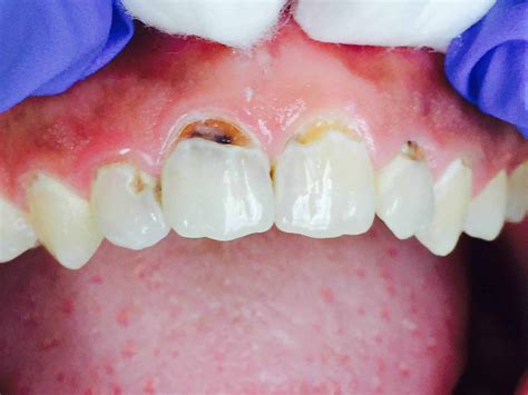 Sugary Drinks Like Mountain Dew Can Cause Rampant Tooth Decay