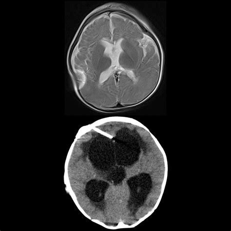 Pediatric Ventriculoperitoneal Shunt Malfunction / Malposition ...