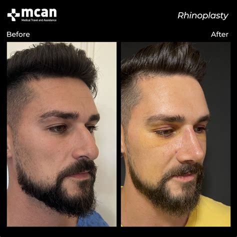 ¿Necesitas Operacion De Nariz? Los Básicos De La Rinoplastia | MCAN Health Blog