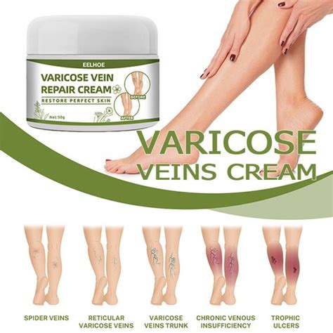 Vasculitis Ointment Leg Swelling Care Cream Varicose India | Ubuy