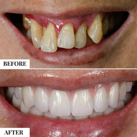 Same Day Teeth Implants Delhi India Immediate Loading Implants Cost ...