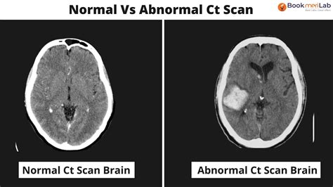 Image result for Normal Brain CT Scan