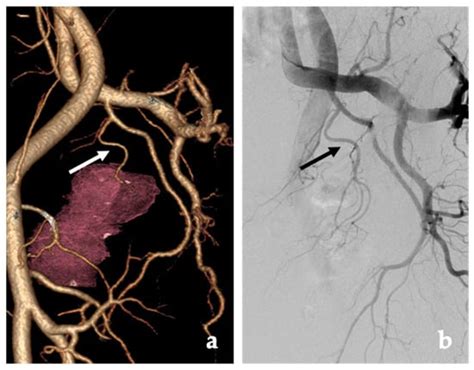 Prostate Artery Embolization—Review of Indications, Patient Selection ...