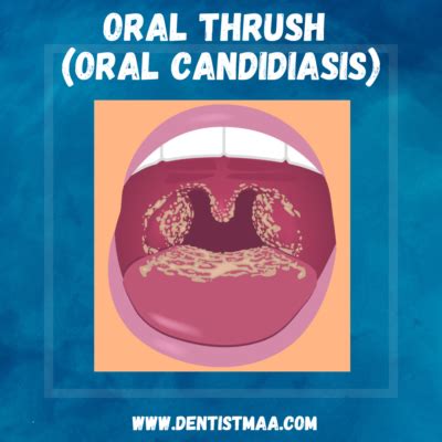 Oral thrush (Oral Candidiasis): Proven Facts - DentistMaa