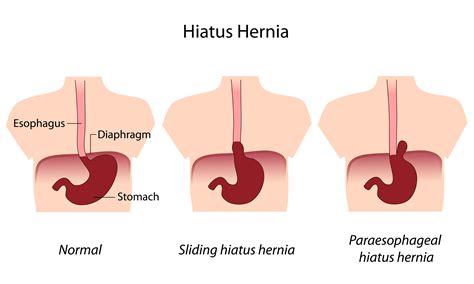 What is Hiatal hernia?