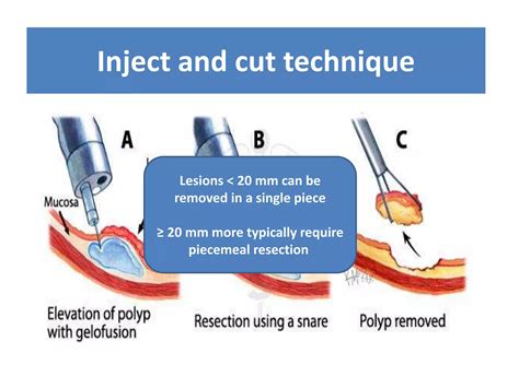 Endoscopic Mucosal Resection